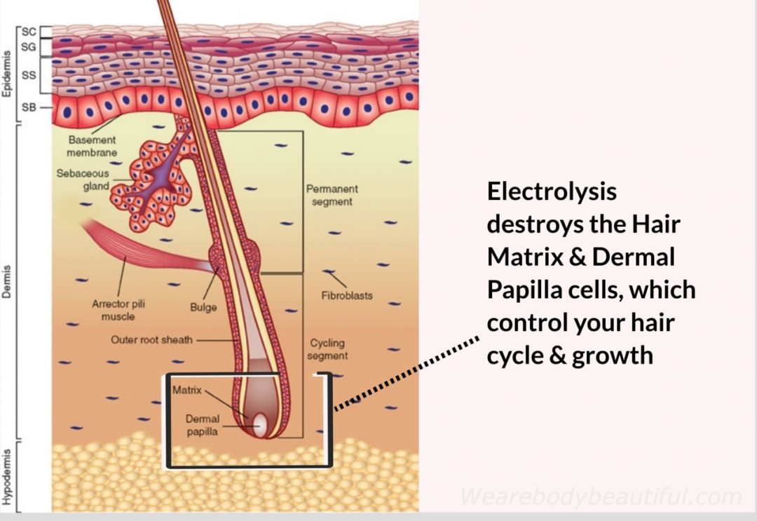 Diagram of a hair follicle highlighting 2 areas: the dermal papilla and Hair matrix at the bottom of the hair shaft. Electrolysis destroys the Hair Matrix & Dermal Papilla cells, which control your hair cycle & growth