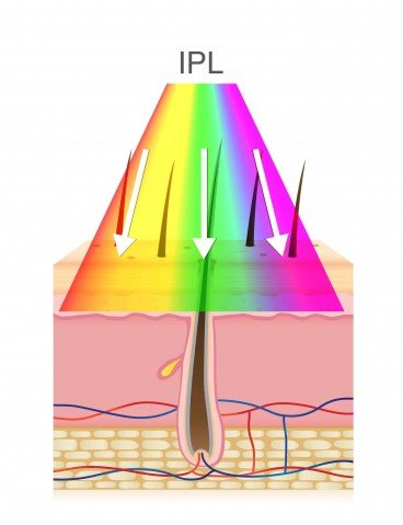 An illustration of a cross section of human skin with multi colour/wavelength Intense Pulsed Light flashing it and absorbing in a dark hair follicle for IPL hair removal.