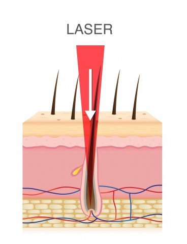 An illustration of a cross section of human skin with a red laser energy beam focused on a dark hair follicle for laser hair removal.