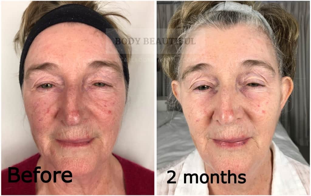 Mira-skin ultrasound review before vs after 2 months comparison photos of my Mam's face using the Mira-skin Ultrasound tool and Hyaluronic Acid Serum.