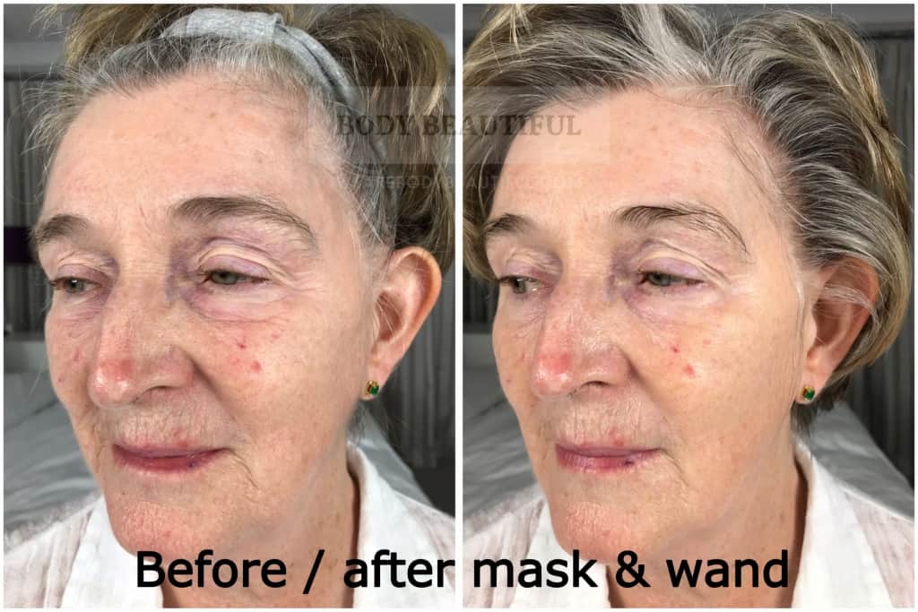 Mira-skin ultrasound review before vs after angled comparison photos of the Mira-skin hyperhydration mask with ultrasound boost. Results are impressive!