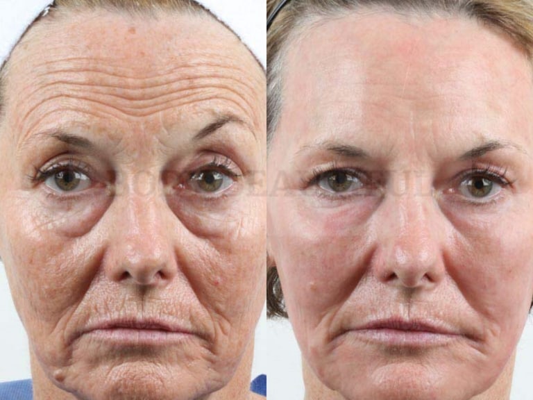 Side by side comparison of the before and after healing photos for a CO" ablative laser patient