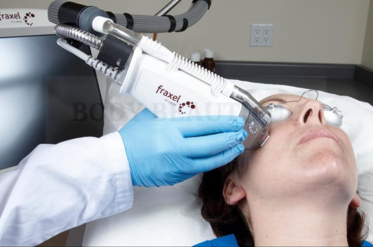 Photo of a lady undergoing Fraxel re:store non-ablative fractional laser resurfacing