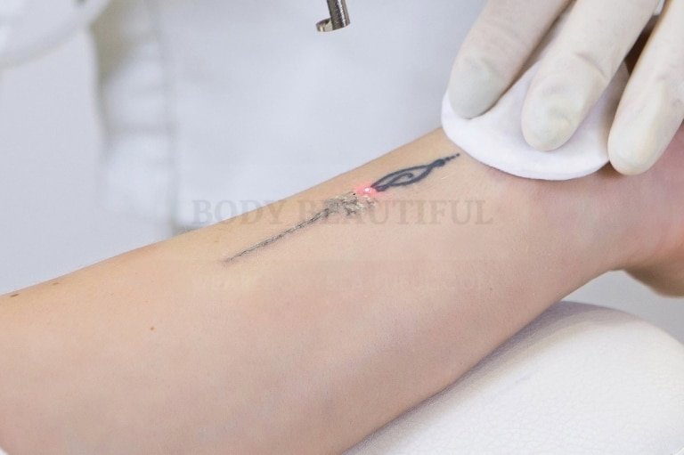 Photo of laser tattoo removal treatment