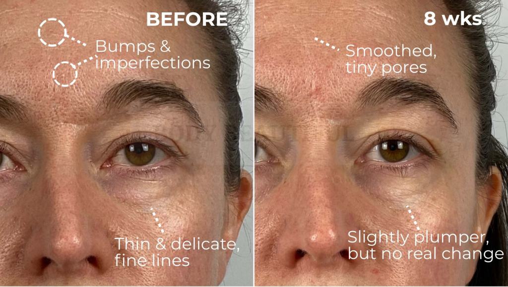 8 weeks os using the Tripollar STOP has smoothed out a few bumps and imperfections on my forehead, and my pores are teeny! The skin under my eyes is maybe a little plumper.