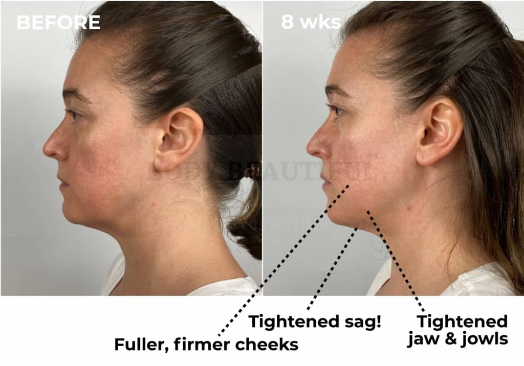 In this side profile comparison photo you can see that the Tripollar STOP has lifted my under-chin sag a little, and tightened my jaw and jowls area. I also have firmer and fuller cheeks.