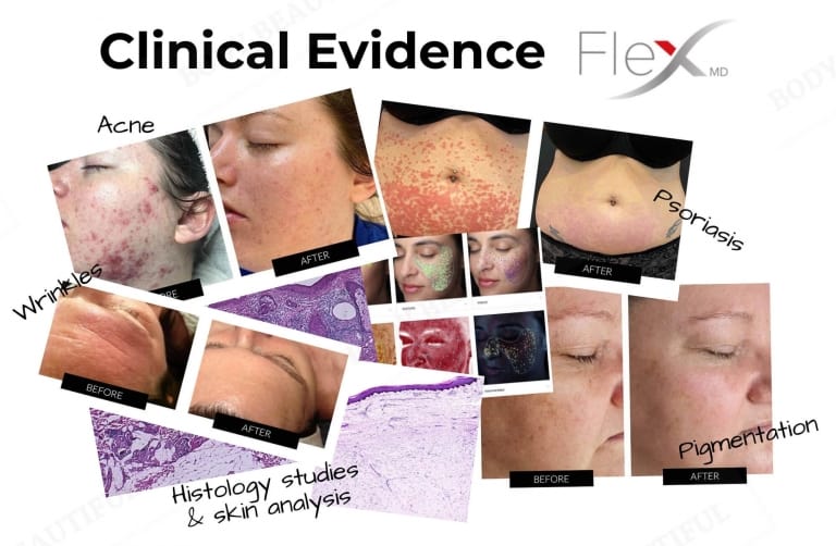 The Flex MD has detailed and braod evidence showing it works including photos, histology studies and skin analysis