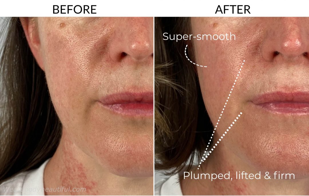 Dermalux Flex MD review before and after light therapy for 5 weeks comparison photos: this close-up of my mouth and cheek shows a marked change in how plump, lifted and firm my mouth area is.
